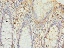GTF3C6 Antibody - Immunohistochemistry of paraffin-embedded human colon cancer using antibody at dilution of 1:100.