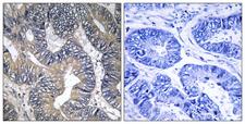 GTPBP2 Antibody - Immunohistochemistry analysis of paraffin-embedded human colon carcinoma tissue, using GTPBP2 Antibody. The picture on the right is blocked with the synthesized peptide.