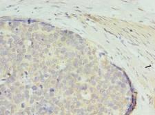 GTPBP6 Antibody - Immunohistochemistry of paraffin-embedded human gastric cancer using antibody at dilution of 1:100.