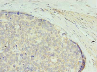 GTPBP6 Antibody - Immunohistochemistry of paraffin-embedded human gastric cancer using GTPBP6 Antibody at dilution of 1:100