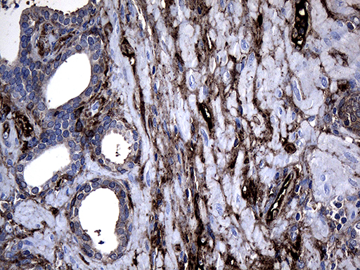 GTPCH1 / GCH1 Antibody - Immunohistochemical staining of paraffin-embedded Carcinoma of Human prostate tissue using anti-GCH1 mouse monoclonal antibody. (Heat-induced epitope retrieval by 1mM EDTA in 10mM Tris buffer. (pH8.5) at 120°C for 3 min. (1:500)