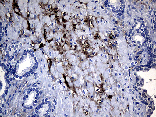 GTPCH1 / GCH1 Antibody - Immunohistochemical staining of paraffin-embedded Carcinoma of Human prostate tissue using anti-GCH1 mouse monoclonal antibody. (Heat-induced epitope retrieval by 1mM EDTA in 10mM Tris buffer. (pH8.5) at 120°C for 3 min. (1:150)(1:500)
