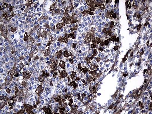 GTPCH1 / GCH1 Antibody - Immunohistochemical staining of paraffin-embedded Human lymphoma tissue using anti-GCH1 mouse monoclonal antibody. (Heat-induced epitope retrieval by 1mM EDTA in 10mM Tris buffer. (pH8.5) at 120°C for 3 min. (1:500)