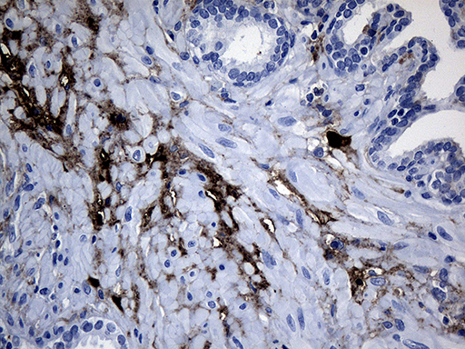 GTPCH1 / GCH1 Antibody - Immunohistochemical staining of paraffin-embedded Carcinoma of Human prostate tissue using anti-GCH1 mouse monoclonal antibody. (Heat-induced epitope retrieval by 1mM EDTA in 10mM Tris buffer. (pH8.5) at 120°C for 3 min. (1:500)