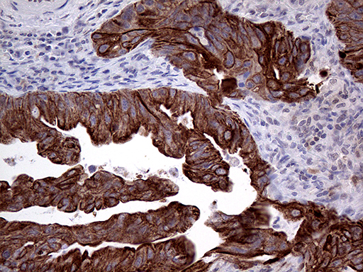 GTPCH1 / GCH1 Antibody - Immunohistochemical staining of paraffin-embedded Human spleen carcinoma tissue within the normal limits using anti-GCH1 mouse monoclonal antibody. (1:500)