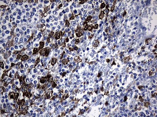 GTPCH1 / GCH1 Antibody - Immunohistochemical staining of paraffin-embedded Human lymphoma tissue using anti-GCH1 mouse monoclonal antibody. (Heat-induced epitope retrieval by 1mM EDTA in 10mM Tris buffer. (pH8.5) at 120°C for 3 min. (1:500)
