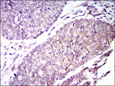 GUCY1A1 / GUCY1A3 Antibody - IHC of paraffin-embedded esophageal cancer tissues using GUCY1A3 mouse monoclonal antibody with DAB staining.