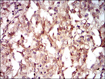 GUCY1A1 / GUCY1A3 Antibody - IHC of paraffin-embedded renal cancer tissues using GUCY1A3 mouse monoclonal antibody with DAB staining.