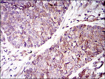 GUCY1A1 / GUCY1A3 Antibody - IHC of paraffin-embedded esophageal cancer tissues using GUCY1A3 mouse monoclonal antibody with DAB staining.