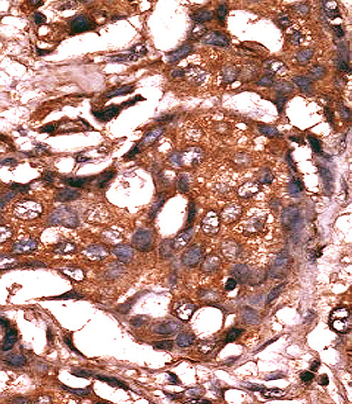 GUCY1A1 / GUCY1A3 Antibody - Formalin-fixed and paraffin-embedded human cancer tissue reacted with the primary antibody, which was peroxidase-conjugated to the secondary antibody, followed by AEC staining. This data demonstrates the use of this antibody for immunohistochemistry; clinical relevance has not been evaluated. BC = breast carcinoma; HC = hepatocarcinoma.
