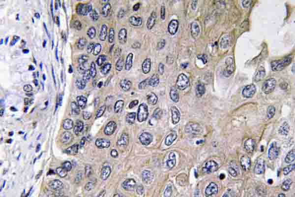 GUCY1A1 / GUCY1A3 Antibody - IHC of GCS--1 (D423) pAb in paraffin-embedded human lung carcinoma tissue.