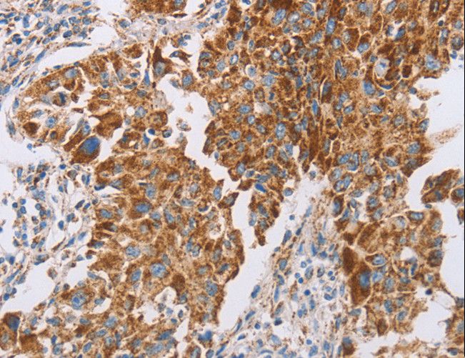 GUCY1A1 / GUCY1A3 Antibody - Immunohistochemistry of paraffin-embedded Human breast cancer using GUCY1A3 Polyclonal Antibody at dilution of 1:40.