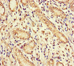 GUCY1A1 / GUCY1A3 Antibody - Immunohistochemistry of paraffin-embedded human gastric cancer at dilution of 1:100