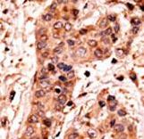 GUCY1A2 Antibody - Formalin-fixed and paraffin-embedded human cancer tissue reacted with the primary antibody, which was peroxidase-conjugated to the secondary antibody, followed by AEC staining. This data demonstrates the use of this antibody for immunohistochemistry; clinical relevance has not been evaluated. BC = breast carcinoma; HC = hepatocarcinoma.