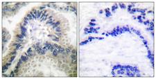 GUCY1B3 Antibody - Peptide - + Immunohistochemical analysis of paraffin-embedded human lung carcinoma tissue using Guanylate Cyclase ß antibody.