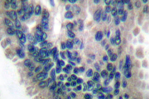 GUCY1B3 Antibody - IHC of Guanylate Cyclase 1/3 (V21) pAb in paraffin-embedded human lung carcinoma tissue.