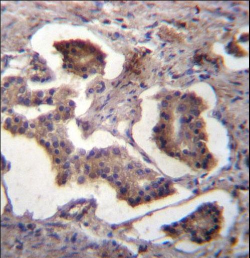 GUF1 Antibody - GUF1 Antibody immunohistochemistry of formalin-fixed and paraffin-embedded human prostate carcinoma followed by peroxidase-conjugated secondary antibody and DAB staining.