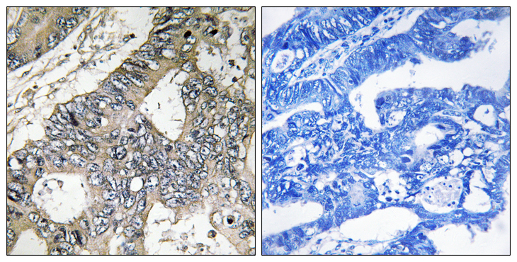 GUF1 Antibody - Immunohistochemistry analysis of paraffin-embedded human colon carcinoma tissue, using GUF1 Antibody. The picture on the right is blocked with the synthesized peptide.