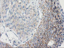 GUK1 / Guanylate Kinase 1 Antibody - IHC of paraffin-embedded Carcinoma of Human bladder tissue using anti-GUK1 mouse monoclonal antibody. (Heat-induced epitope retrieval by 10mM citric buffer, pH6.0, 100C for 10min).