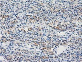 GUK1 / Guanylate Kinase 1 Antibody - IHC of paraffin-embedded Carcinoma of Human thyroid tissue using anti-GUK1 mouse monoclonal antibody. (Heat-induced epitope retrieval by 10mM citric buffer, pH6.0, 100C for 10min).