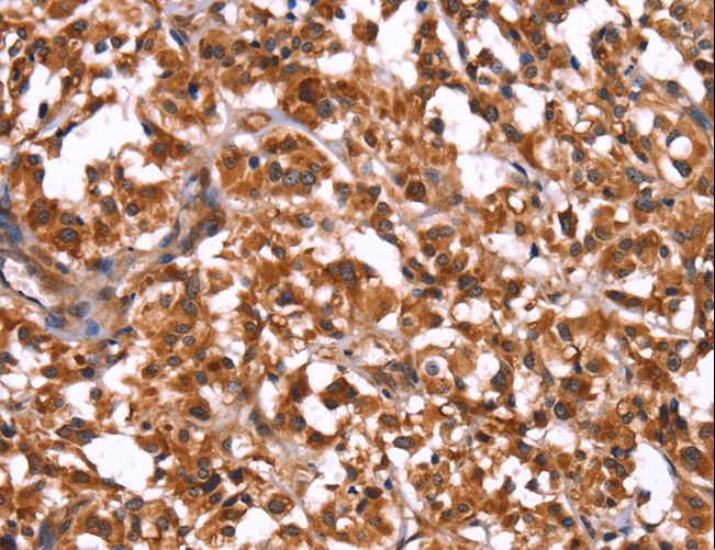 GUK1 / Guanylate Kinase 1 Antibody - Immunohistochemistry of paraffin-embedded Human thyroid cancer using GUK1 Polyclonal Antibody at dilution of 1:50.