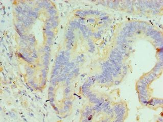 GUSB / Beta Glucuronidase Antibody - Immunohistochemistry of paraffin-embedded human colon cancer using antibody at 1:100 dilution.