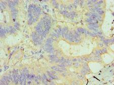 GUSB / Beta Glucuronidase Antibody - Immunohistochemistry of paraffin-embedded human colon cancer using antibody at 1:100 dilution.