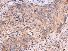 GUSB / Beta Glucuronidase Antibody - Immunohistochemistry of paraffin-embedded Human cervical cancer tissue  using GUSB Polyclonal Antibody at dilution of 1:50(×200)