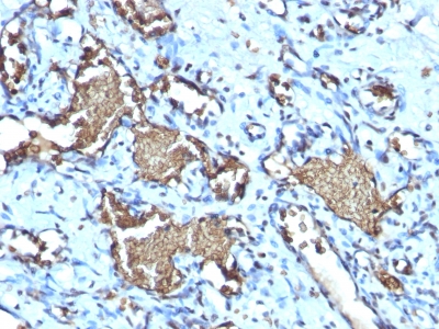 GYPA / CD235a / Glycophorin A Antibody - Formalin-fixed, paraffin-embedded human Angiosarcoma stained with Glycophorin A Rabbit Recombinant Monoclonal Antibody (GYPA/1725R).