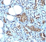 GYPA / CD235a / Glycophorin A Antibody - Formalin-fixed, paraffin-embedded human angiosarcoma stained with Glycophorin A antibody (GYPA/280).  This image was taken for the unmodified form of this product. Other forms have not been tested.