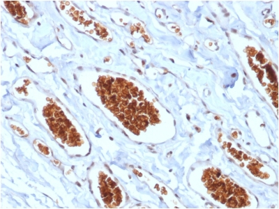 GYPA / CD235a / Glycophorin A Antibody - Formalin-fixed, paraffin-embedded human Angiosarcoma stained with Glycophorin A Mouse Recombinant Monoclonal Antibody (rGYPA/280).