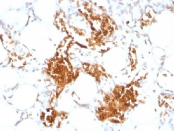 GYPA / CD235a / Glycophorin A Antibody - IHC testing of FFPE human angiosarcoma stained with anti-Glycophorin A antibody (clone SPM599)