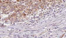 GYPA / CD235a / Glycophorin A Antibody - 1:100 staining human liver carcinoma tissues by IHC-P. The sample was formaldehyde fixed and a heat mediated antigen retrieval step in citrate buffer was performed. The sample was then blocked and incubated with the antibody for 1.5 hours at 22°C. An HRP conjugated goat anti-rabbit antibody was used as the secondary.