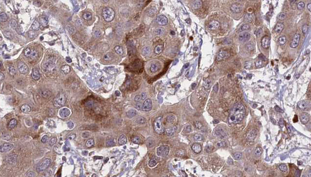 GYPC / Glycophorin C Antibody - 1:100 staining human liver carcinoma tissues by IHC-P. The sample was formaldehyde fixed and a heat mediated antigen retrieval step in citrate buffer was performed. The sample was then blocked and incubated with the antibody for 1.5 hours at 22°C. An HRP conjugated goat anti-rabbit antibody was used as the secondary.