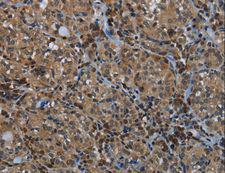GYS1 / Glycogen Synthase Antibody - Immunohistochemistry of paraffin-embedded Human thyroid cancer using GYS1 Polyclonal Antibody at dilution of 1:40.