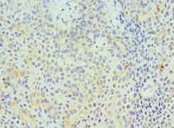 GZMA / Granzyme A Antibody - Immunohistochemistry of paraffin-embedded human breast cancer using antibody at 1:100 dilution.