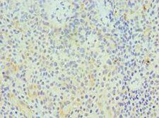 GZMA / Granzyme A Antibody - Immunohistochemistry of paraffin-embedded human breast cancer using antibody at 1:100 dilution.