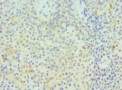 GZMA / Granzyme A Antibody - Immunohistochemistry of paraffin-embedded human breast cancer using GZMA Antibody at dilution of 1:100