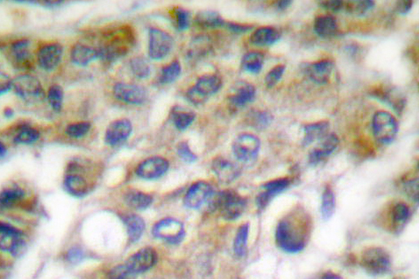 GZMB / Granzyme B Antibody - IHC of Granzyme B/H (E20) pAb in paraffin-embedded human breast carcinoma tissue.
