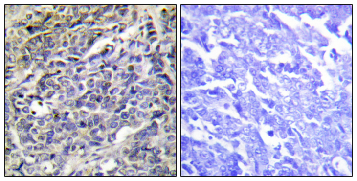 GZMK / Granzyme K Antibody - Immunohistochemistry analysis of paraffin-embedded human lung carcinoma tissue, using GRAK Antibody. The picture on the right is blocked with the synthesized peptide.