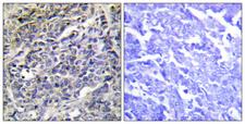 GZMK / Granzyme K Antibody - Immunohistochemistry analysis of paraffin-embedded human lung carcinoma tissue, using GRAK Antibody. The picture on the right is blocked with the synthesized peptide.