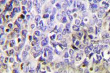 GZMK / Granzyme K Antibody - IHC of Granzyme K (H85) pAb in paraffin-embedded human lung carcinoma tissue.