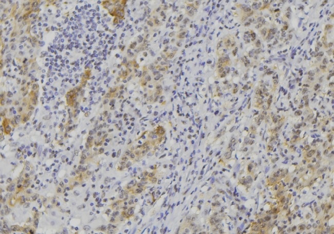GZMK / Granzyme K Antibody - 1:100 staining human lung carcinoma tissue by IHC-P. The sample was formaldehyde fixed and a heat mediated antigen retrieval step in citrate buffer was performed. The sample was then blocked and incubated with the antibody for 1.5 hours at 22°C. An HRP conjugated goat anti-rabbit antibody was used as the secondary.