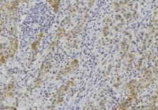 GZMK / Granzyme K Antibody - 1:100 staining human lung carcinoma tissue by IHC-P. The sample was formaldehyde fixed and a heat mediated antigen retrieval step in citrate buffer was performed. The sample was then blocked and incubated with the antibody for 1.5 hours at 22°C. An HRP conjugated goat anti-rabbit antibody was used as the secondary.