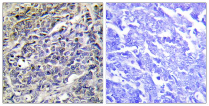 GZMK / Granzyme K Antibody - Peptide - + Immunohistochemistry analysis of paraffin-embedded human lung carcinoma tissue using GRAK antibody.