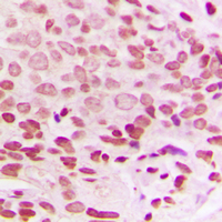 H1F0 Antibody - Immunohistochemical analysis of Histone H1.0 staining in human breast cancer formalin fixed paraffin embedded tissue section. The section was pre-treated using heat mediated antigen retrieval with sodium citrate buffer (pH 6.0). The section was then incubated with the antibody at room temperature and detected using an HRP conjugated compact polymer system. DAB was used as the chromogen. The section was then counterstained with hematoxylin and mounted with DPX.