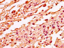 H1F0 Antibody - Immunohistochemistry image at a dilution of 1:50 and staining in paraffin-embedded human melanoma cancer performed on a Leica BondTM system. After dewaxing and hydration, antigen retrieval was mediated by high pressure in a citrate buffer (pH 6.0) . Section was blocked with 10% normal goat serum 30min at RT. Then primary antibody (1% BSA) was incubated at 4 °C overnight. The primary is detected by a biotinylated secondary antibody and visualized using an HRP conjugated SP system.