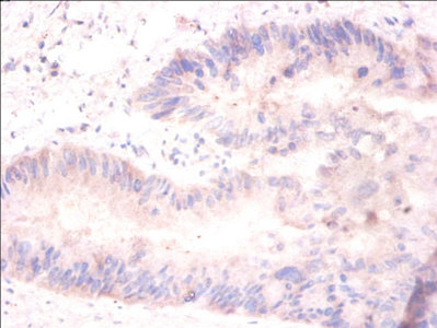 H2AFJ Antibody - Immunohistochemistry of paraffin-embedded human colon cancer using H2AFJ Antibody at dilution of 1:100