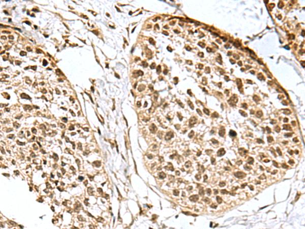 H2AFJ Antibody - Immunohistochemistry of paraffin-embedded Human esophagus cancer tissue  using H2AFJ Polyclonal Antibody at dilution of 1:170(×200)