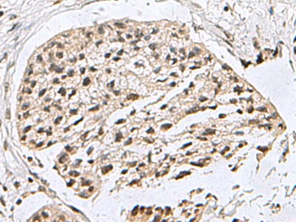 H2AFJ Antibody - Immunohistochemistry of paraffin-embedded Human esophagus cancer tissue  using H2AFJ Polyclonal Antibody at dilution of 1:160(×200)